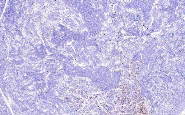 3C1 Medulloblastoma, desmoplastic (Case 3) GFAP 4X