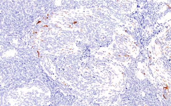 3C2 Medulloblastoma, desmoplastic (Case 3) GFAP 20X