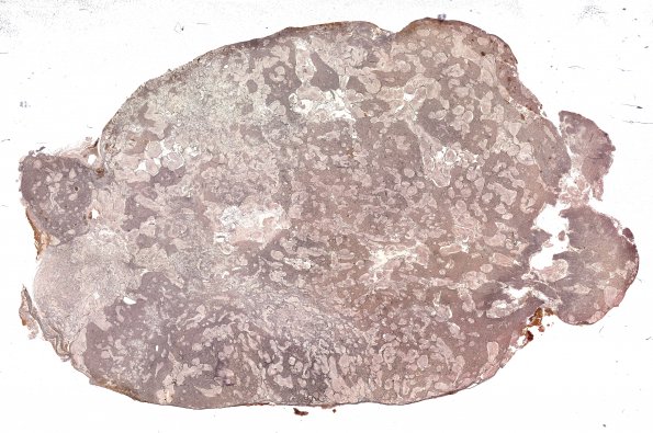 3D1 Medulloblastoma (Case 3) Retic 3