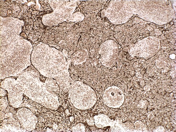 3D3 Medulloblastoma (Case 3) Retic 2