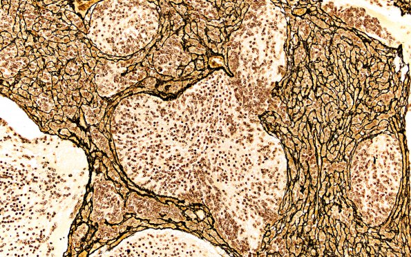 3D4 Medulloblastoma (Case 3) Retic 20X