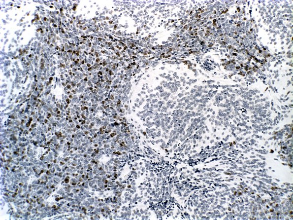 3E2 Medulloblastoma, desmoplastic (Case 3) MIB 2