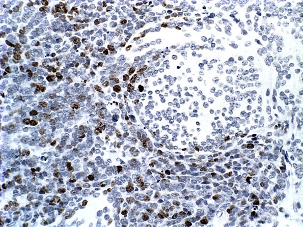 3E3 Medulloblastoma, desmoplastic (Case 3) MIB 1