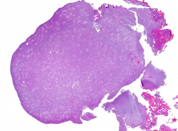 4A1 Medulloblastoma, desmoplastic-nodular (Case 4) H&E WM