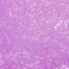 4A2 Medulloblastoma, desmoplastic-nodular (Case 4) H&E 2X