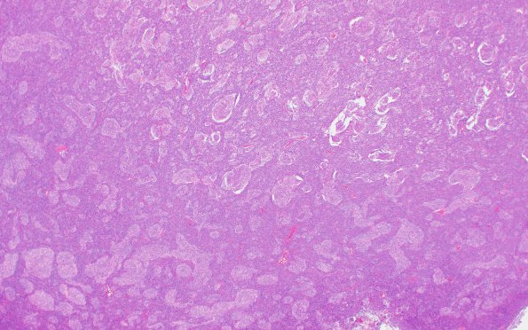 4A2 Medulloblastoma, desmoplastic-nodular (Case 4) H&E 2X