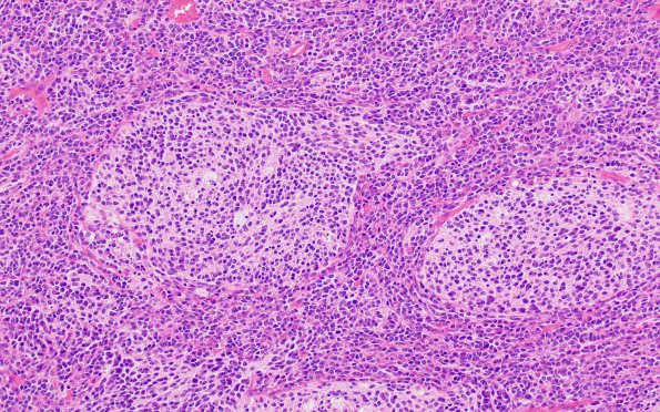 4A4 Medulloblastoma, desmoplastic-nodular (Case 4) H&E 20X