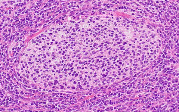 4A5 Medulloblastoma, desmoplastic-nodular (Case 4) H&E 40X