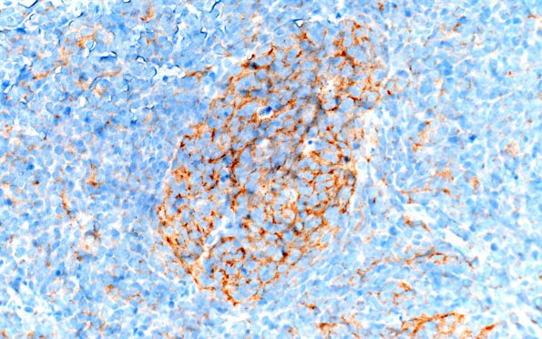 4B Medulloblastoma, desmoplastic-nodular (Case 4) SYN 40X 2