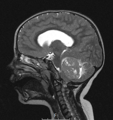 5A2 Medulloblastoma, Desmoplastic (Case 5)  T2 1 - Copy