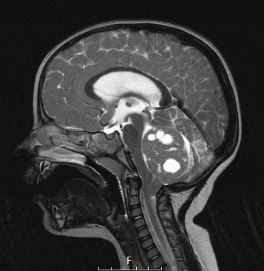 5A3 Medulloblastoma, Desmoplastic (Case 5)  T2 2 - Copy