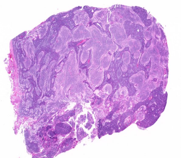 5B1 Medulloblastoma, Desmoplastic (Case 5) H&E WM