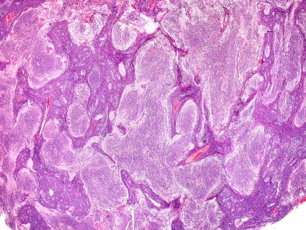 5B2 Medulloblastoma, Desmoplastic (Case 5) H&E 1