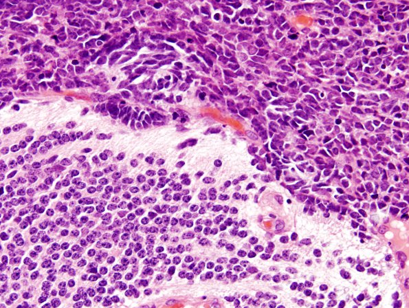 5B3 Medulloblastoma, Desmoplastic (Case 5) H&E 2