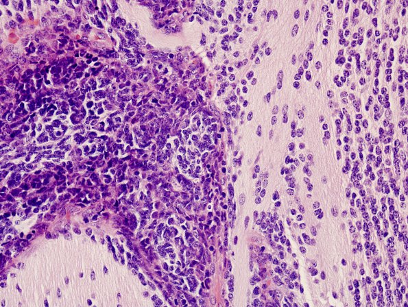 5B4 Medulloblastoma, Desmoplastic (Case 5) H&E 4