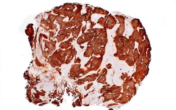5C1 Medulloblastoma, Desmoplastic (Case 5)  SYN 2X 2