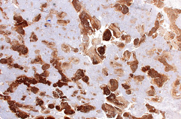 5C2 Medulloblastoma, Desmoplastic (Case 5) SYN 2X