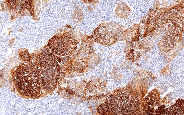 5C4 Medulloblastoma, Desmoplastic (Case 5) SYN 10X