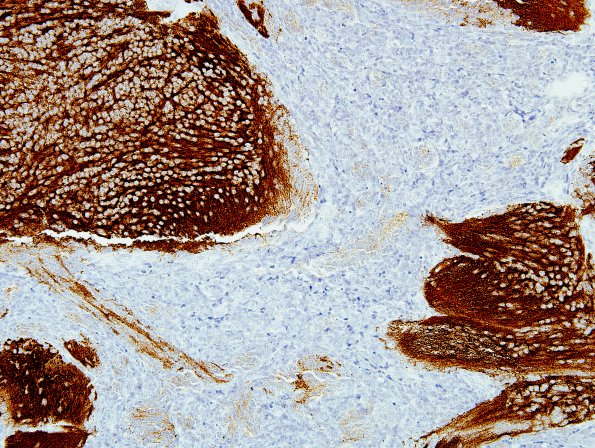 5C5 Medulloblastoma, Desmoplastic (Case 5) SYN 2