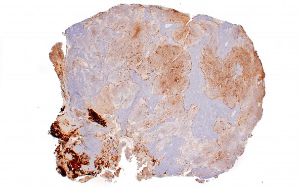 5D1 Medulloblastoma, Desmoplastic (Case 5) GFAP 2X