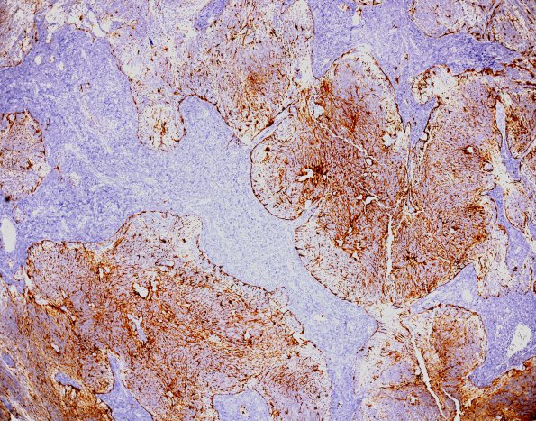 5D2 Medulloblastoma, Desmoplastic (Case 5) GFAP 1