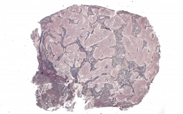 5E1 Medulloblastoma, Desmoplastic (Case 5) Retic 2X 2
