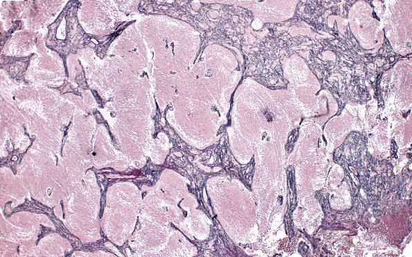 5E2 Medulloblastoma, Desmoplastic (Case 5)  Retic 4X 12