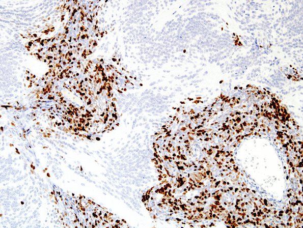 5F3 Medulloblastoma, Desmoplastic (Case 5) MIB 3