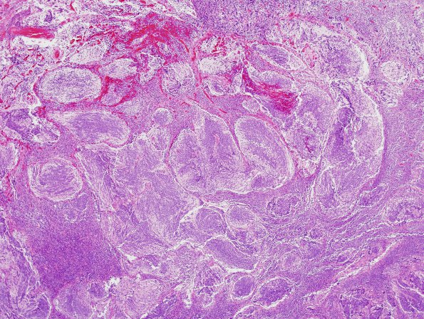 6B2 Medulloblastoma, desmoplastic (Case 6) H&E 1