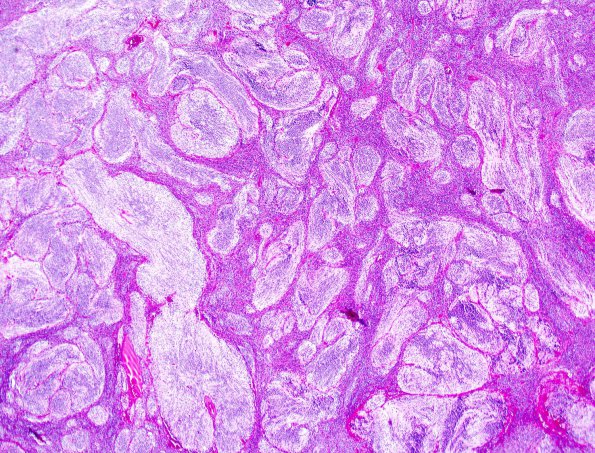 6B3 Medulloblastoma, desmoplastic (Case 6) H&E 1 (2).jpg