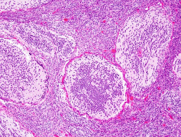 6B4 Medulloblastoma, desmoplastic (Case 6) 3.jpg