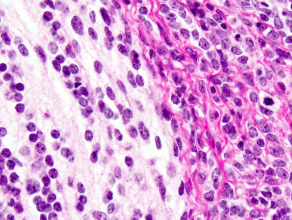 6B5 Medulloblastoma, desmoplastic (Case 6) 4.jpg