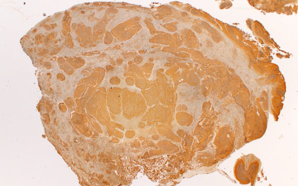 6C1 Medulloblastoma, desmoplastic (Case 6) SYN 2X