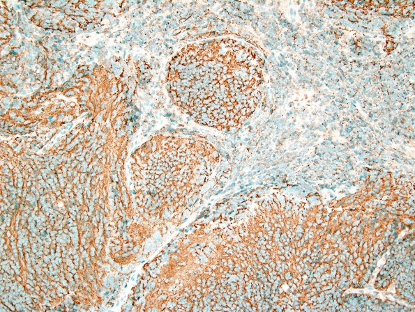 6C3 Medulloblastoma, desmoplastic (Case 6) SYN 2.jpg