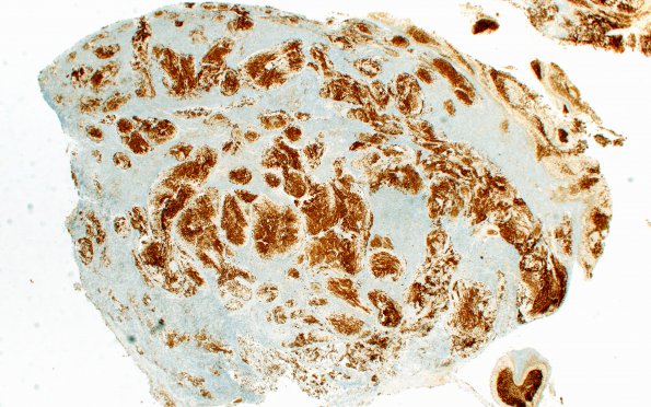 6D1 Medulloblastoma, desmoplastic (Case 6) NEUN 2X