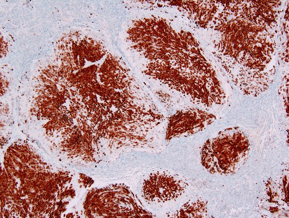 6D3 Medulloblastoma, desmoplastic (Case 6) Neu-N 1.jpg