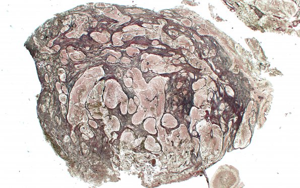 6E1 Medulloblastoma, desmoplastic (Case 6) Retic 2X