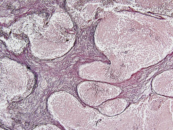 6E2 Medulloblastoma, desmoplastic (Case 6) Retic 1.jpg