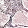 6E3 Medulloblastoma, desmoplastic (Case 6) Retic 2.jpg