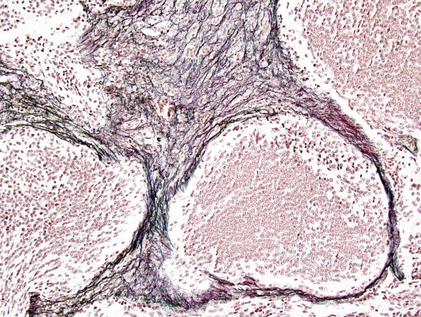 6E3 Medulloblastoma, desmoplastic (Case 6) Retic 2.jpg