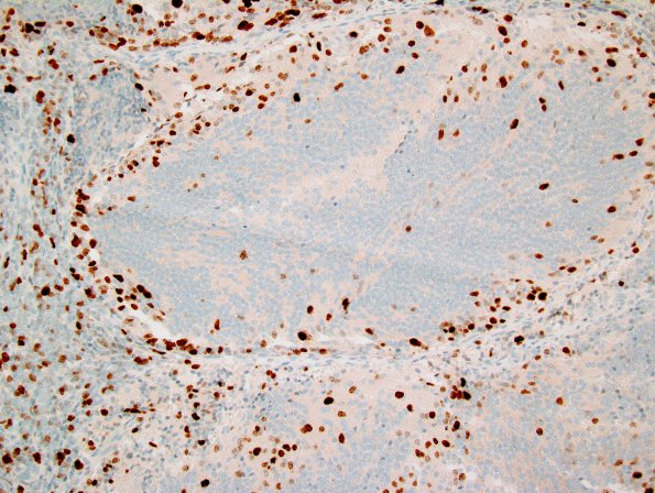 6F2 Medulloblastoma, desmoplastic (Case 6) MIB1 2.jpg