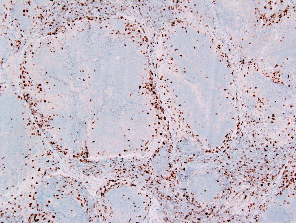 6F3 Medulloblastoma, desmoplastic (Case 6) MIB1 1.jpg