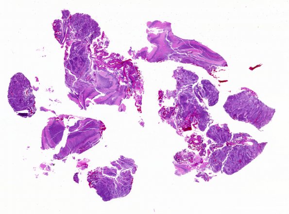 7A1 Medulloblastoma, desmoplastic (Case 7) H&E WM 1