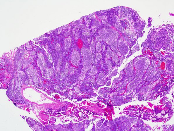 7A2 Medulloblastoma, desmoplastic (S09-29798) H&E 1.jpg