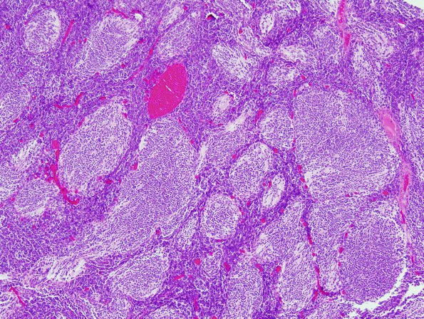 7A3 Medulloblastoma, desmoplastic (S09-29798) H&E 2.jpg