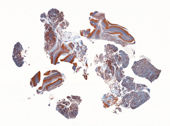 7B1 Medulloblastoma, desmoplastic (Case 7) SYN WM 1