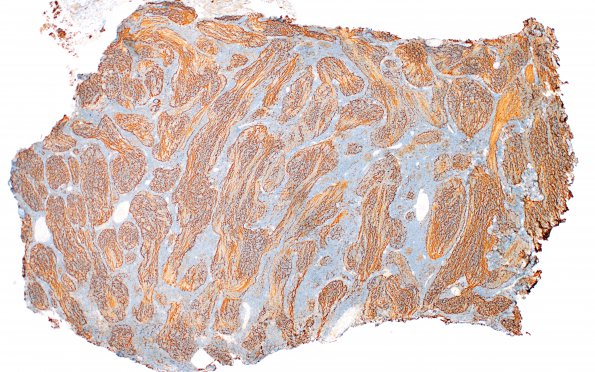 7B2 Medulloblastoma, desmoplastic (Case 7) SYN 4X