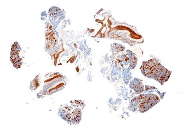 7C1 Medulloblastoma, desmoplastic (Case 7) Neu-N WM 1