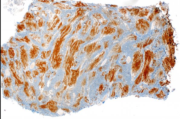 7C2 Medulloblastoma, desmoplastic (Case 7) NeuN 4xA