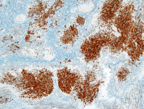 7C3 Medulloblastoma, desmoplastic (Case 7) Neu-N 1.jpg